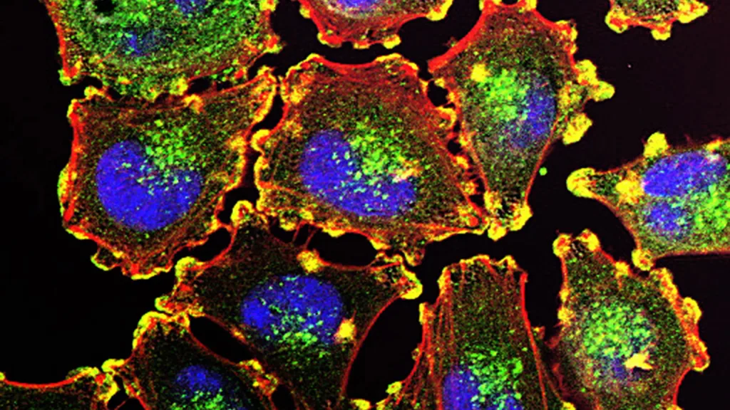 A close up of Metastatic Melanoma Cells. Image courtesy of NIH.